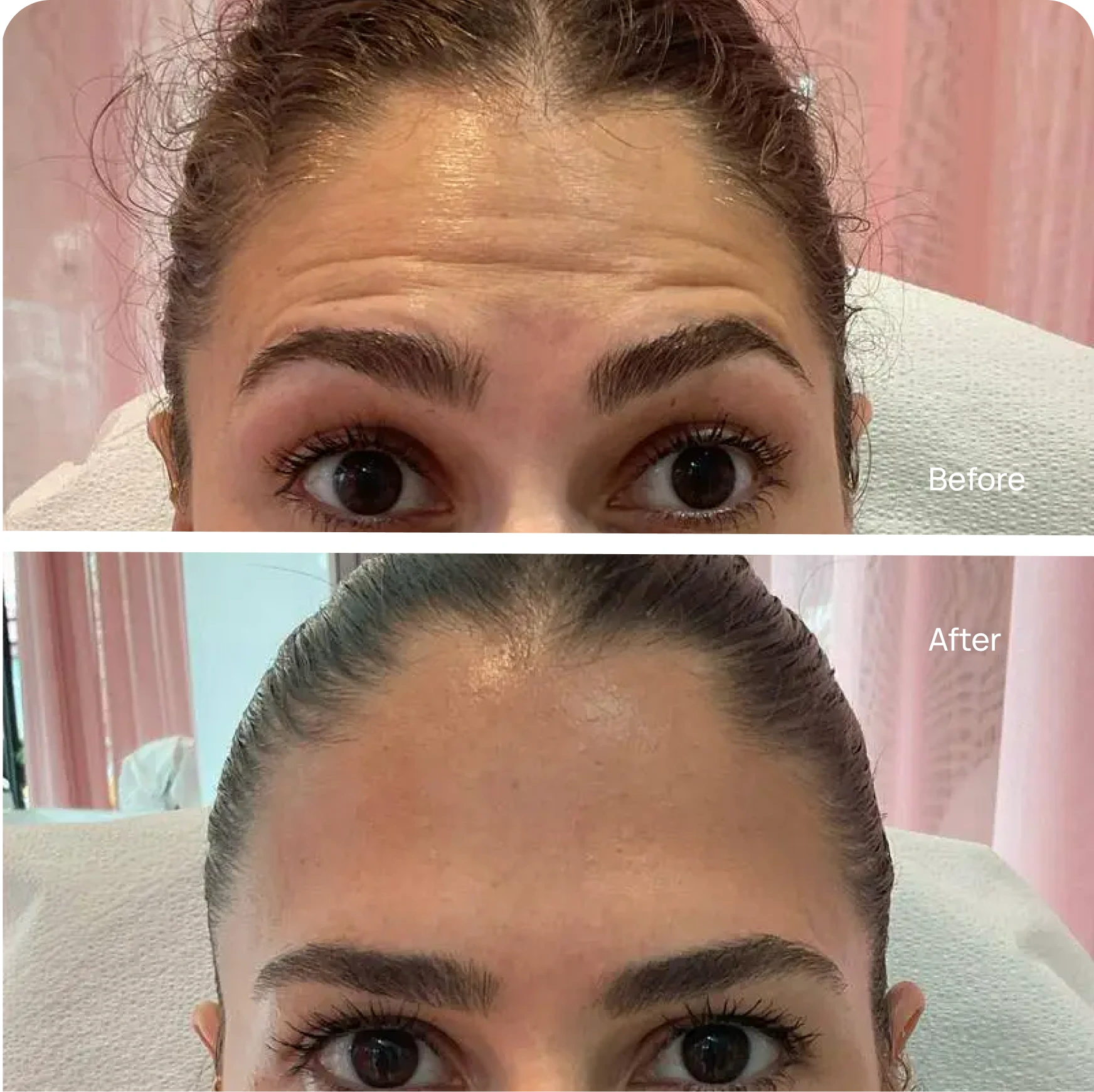 Botox before and after