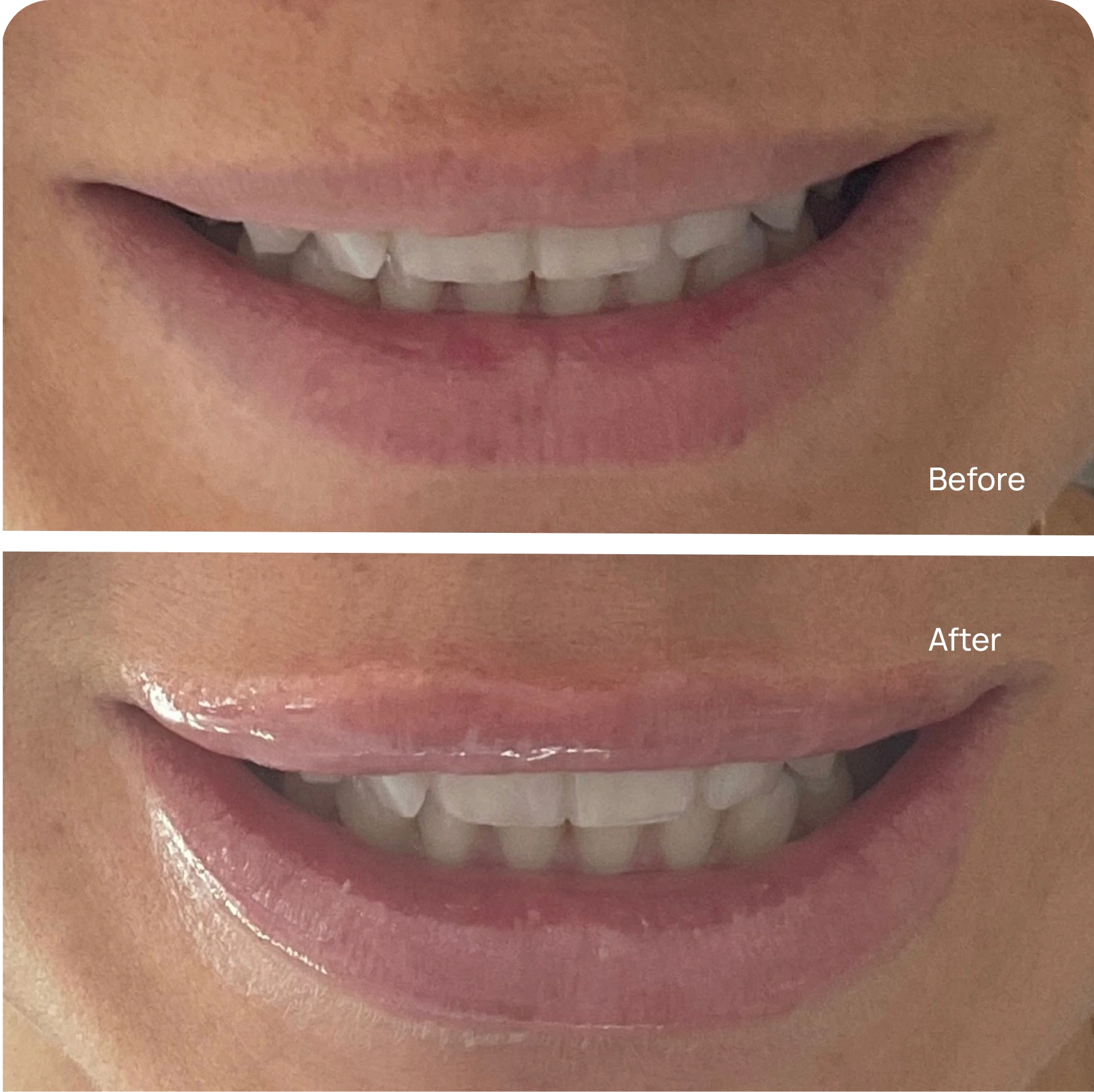 Lip flip before and after