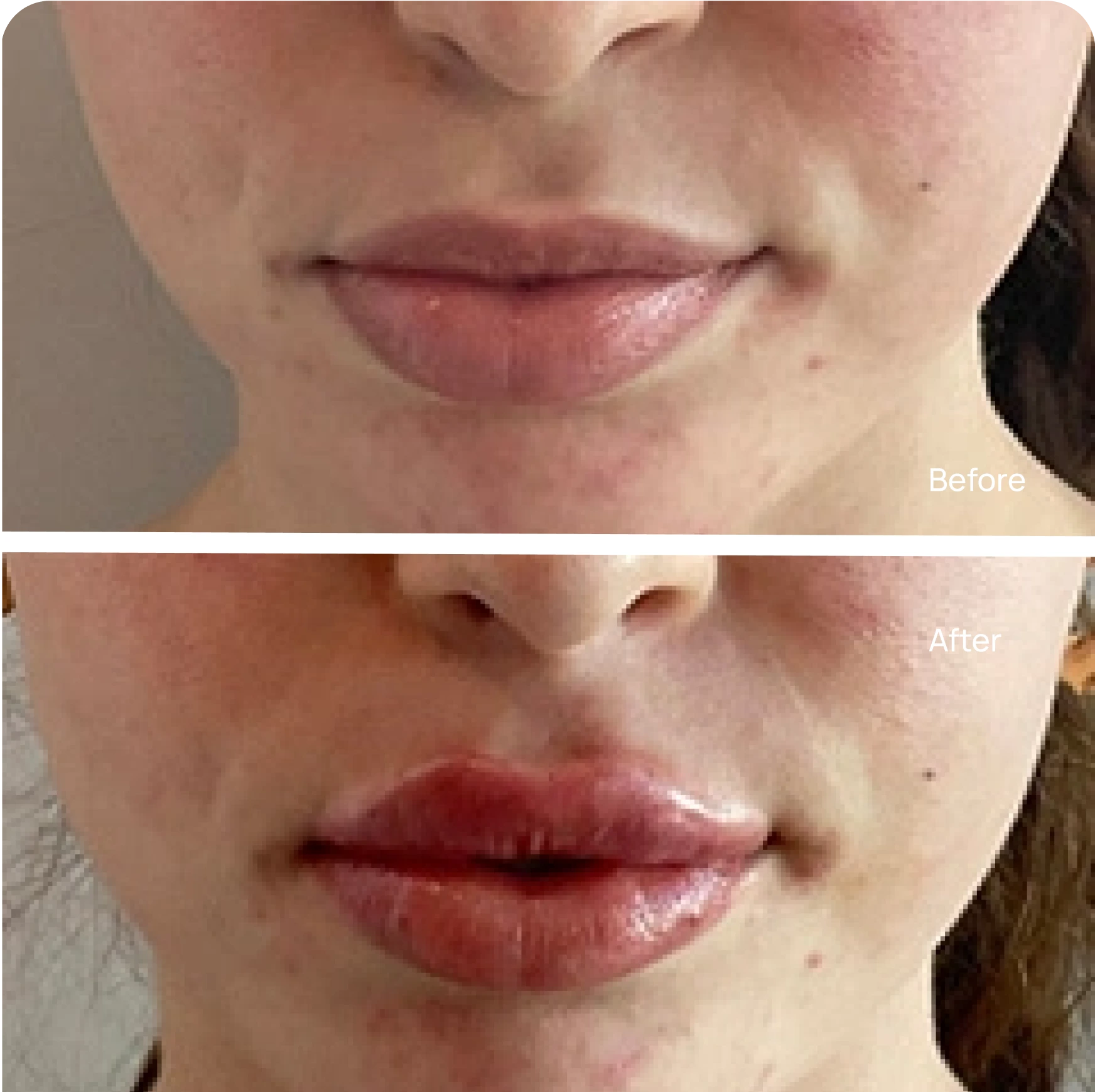 Lip filler before and after