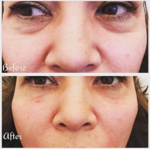 Under eye trough area treated with fillers at James Christian Cosmetics in New York.