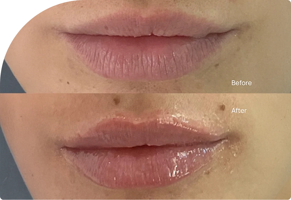 Lip Filler in Long Island Banner