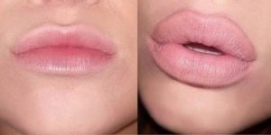 Lip plumping at James Christian Cosmetics in NYC and Long Island. (917) 860-3113