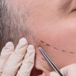 Man beauty procedure beard hair implant for senior man