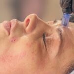 Difference Between Morpheus8 and Microneedling