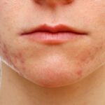 The Role of Your Diet in the Development of Acne