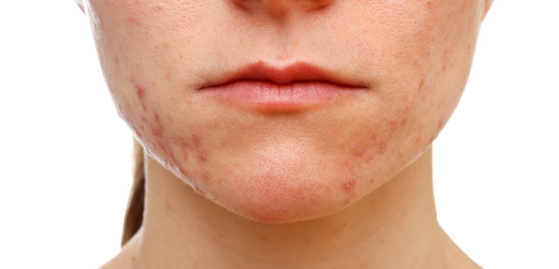 Diet in the development of acne